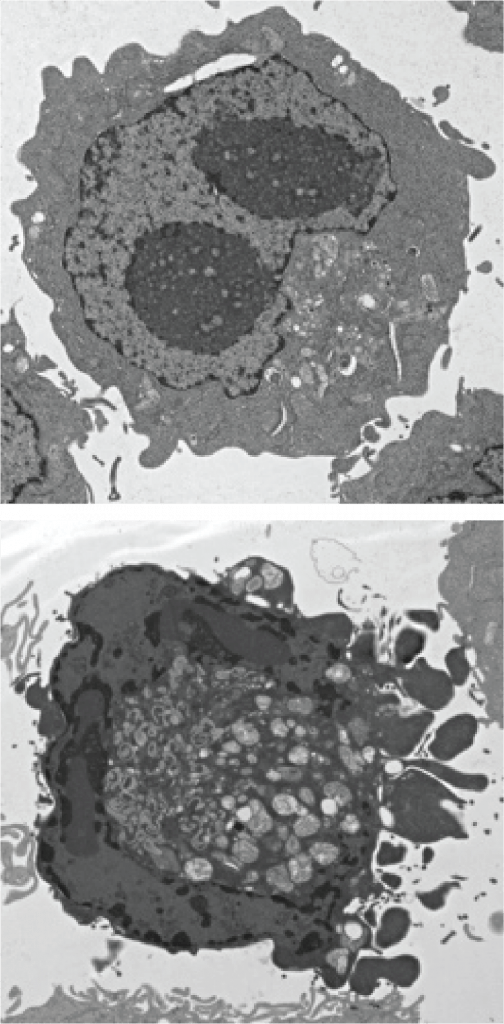 Electron micrograph of Atg5-deficient macrophage either untreated (top) or treated with IFNγ (bottom) and showing hallmarks of apoptotic cell death.